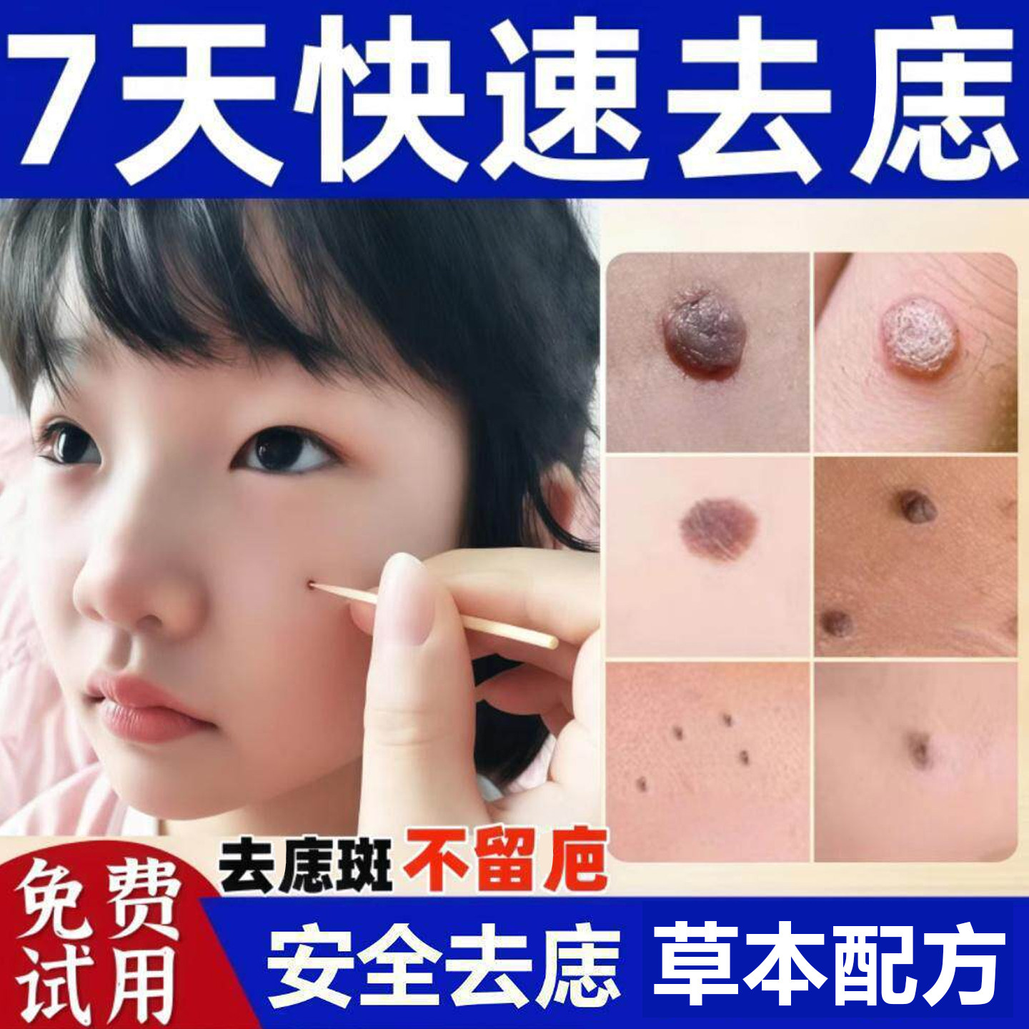 点痣膏无痕点斑疙瘩志脸部专用粒去痣不留疤正品旗舰店脸上肉去除