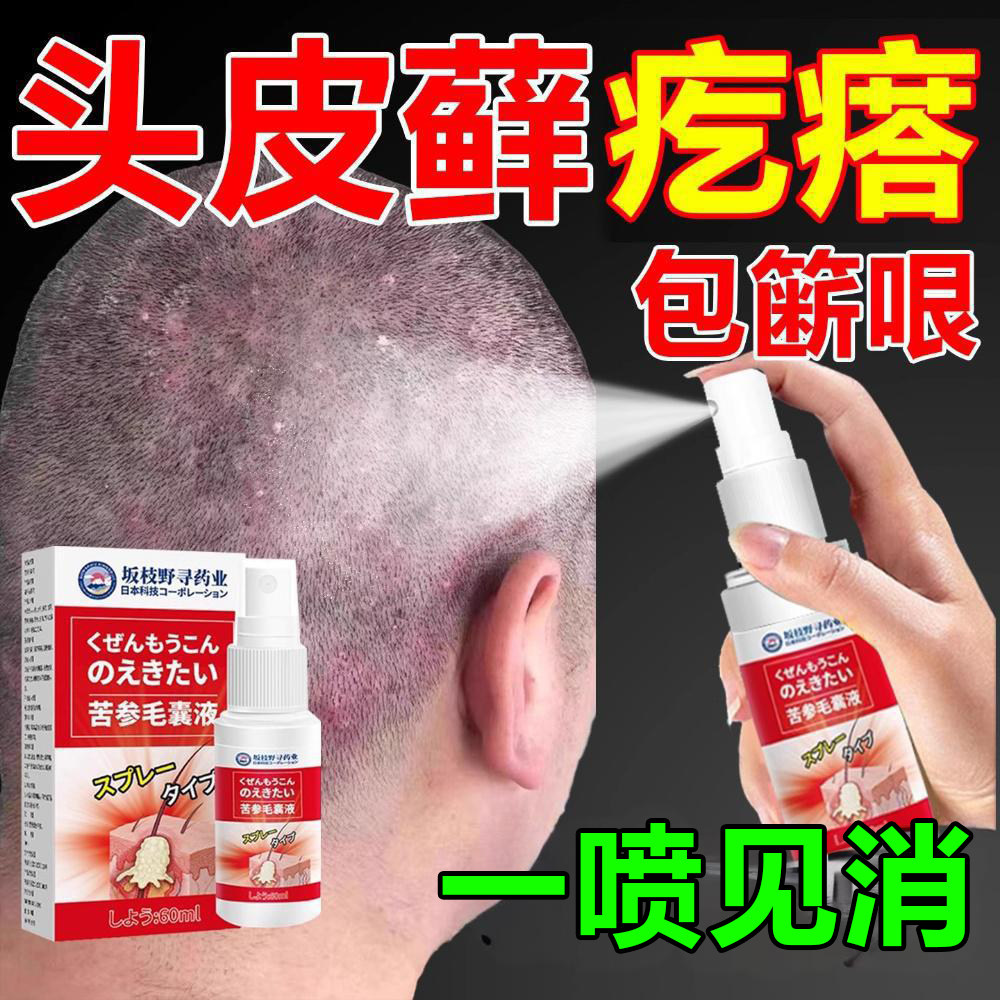 头皮毛囊炎专用头部痒脂溢性皮焱头上长痘痘杀菌痒去屑专用喷剂