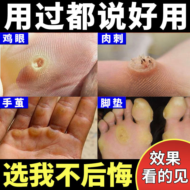 脚底老茧去除神器专用去鸡眼药膏手上脚底足部脚垫正品,洗护清洁剂/卫生巾/纸/香薰,浴足剂,淘宝优惠券,粉丝福利购,淘宝优惠卷