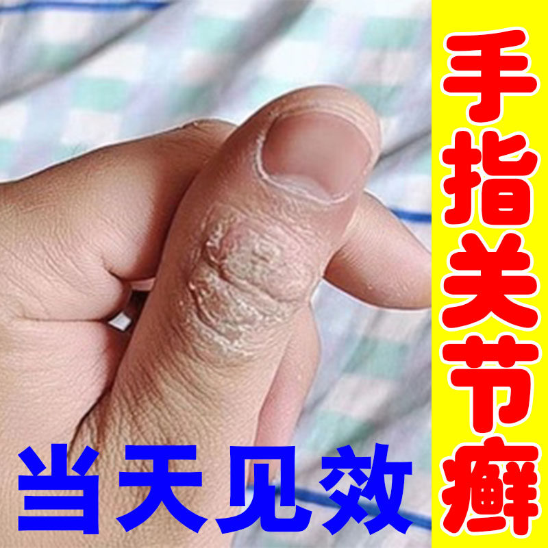 手指关节癣专用手指关节长硬疙瘩去除脱皮开裂手癣真菌感染开裂药