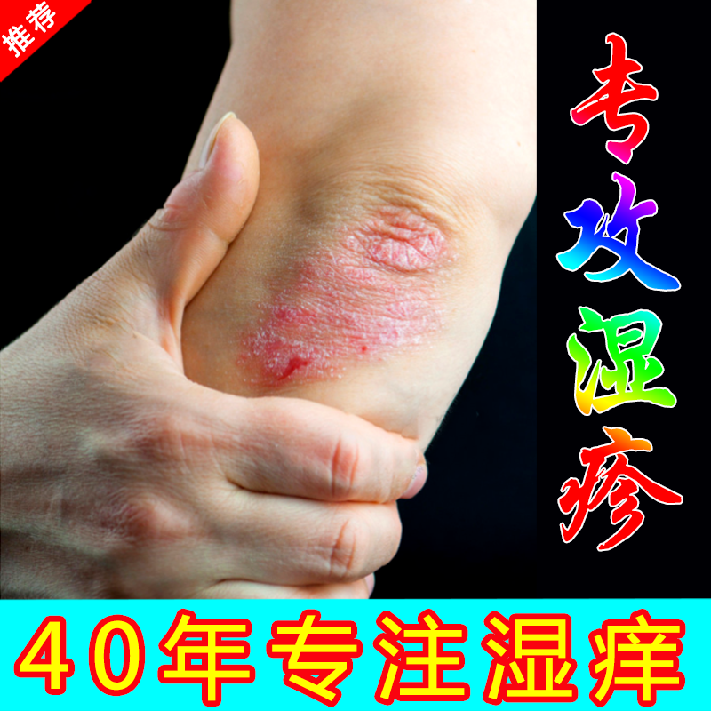 湿疹止痒膏去皮肤干燥瘙痒止痒抑菌全身外用药膏牛皮手脚癣过敏根