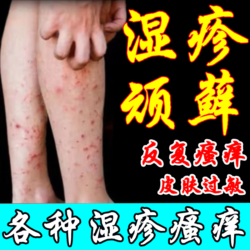 湿疹止痒去皮炎牛皮癣皮肤瘙痒过敏根成人专用瘙痒红疹皮肤用药膏