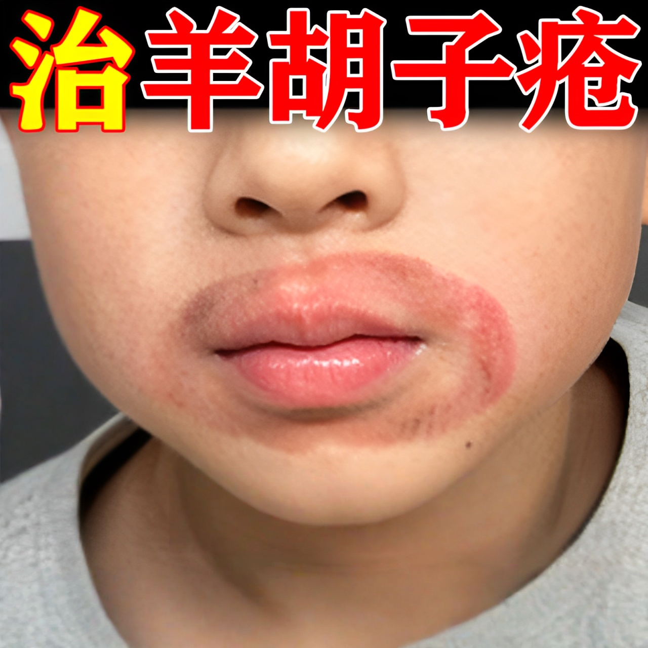【小孩嘴周红】羊胡子疮起泡疹小孩舔嘴唇周焱上火烂嘴发焱专用膏