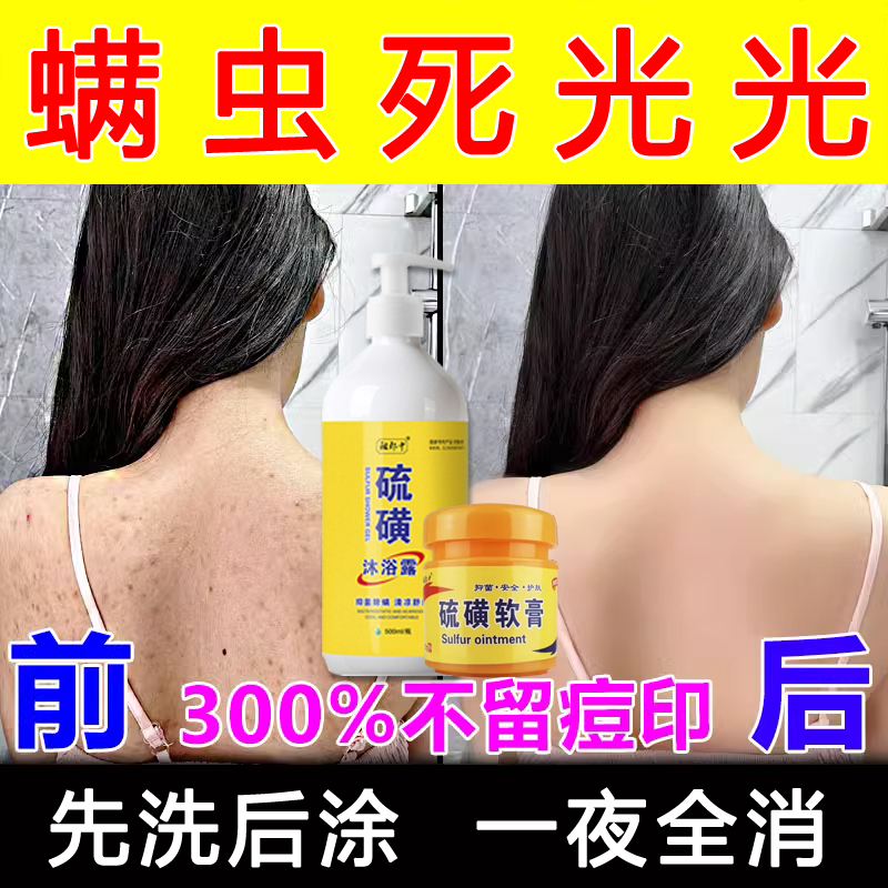 螨虫专用药背上长痘痘后背药膏人用阴虱硫磺皂除螨沐浴露液体皂