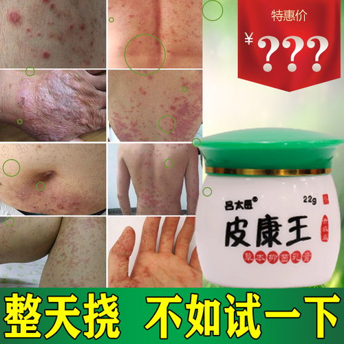 皮康王皮肤外用抑止膏软膏大腿内侧痒屁股男女私处手脚头皮身体痒