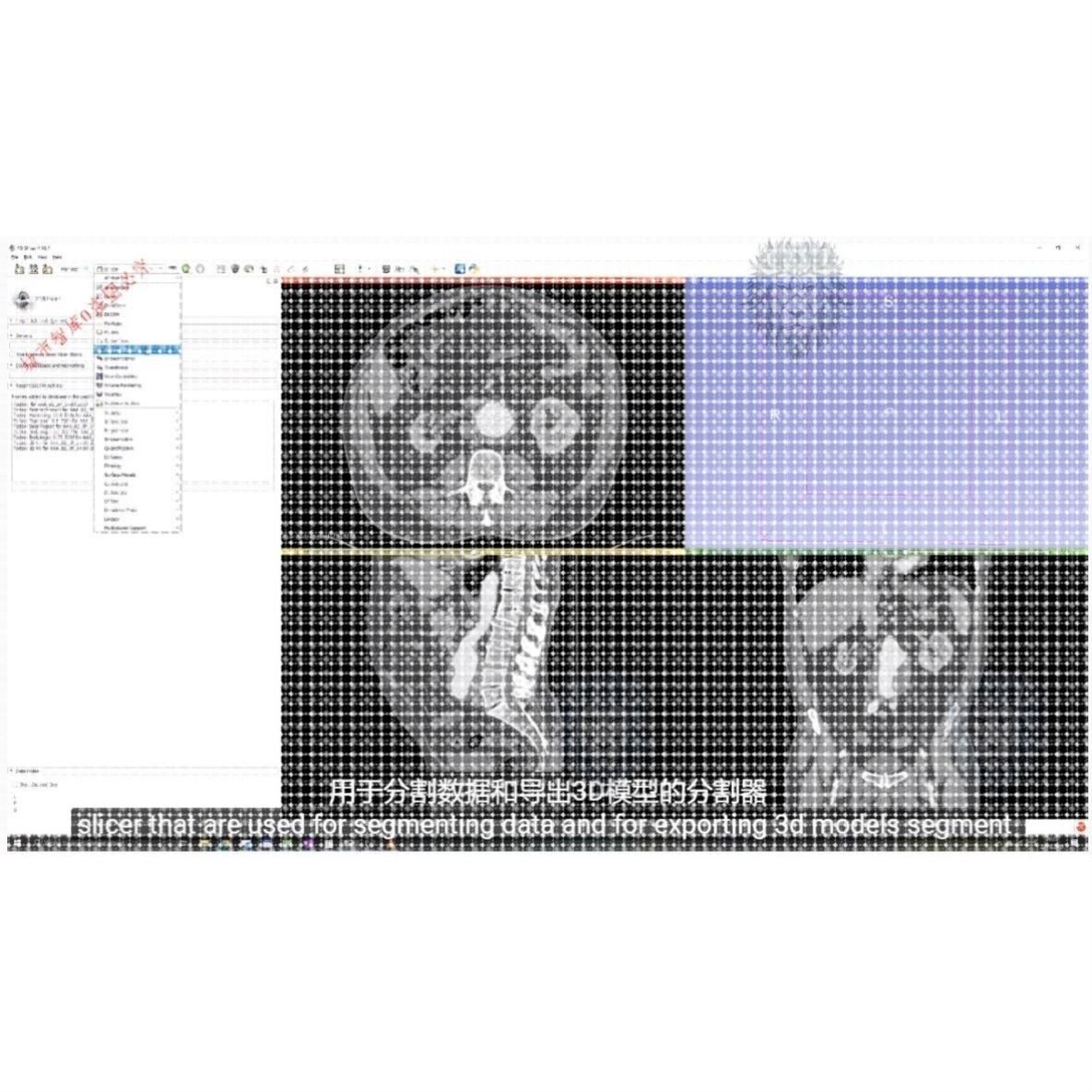 3d slicer医学影像图像分割视频教学教程课程