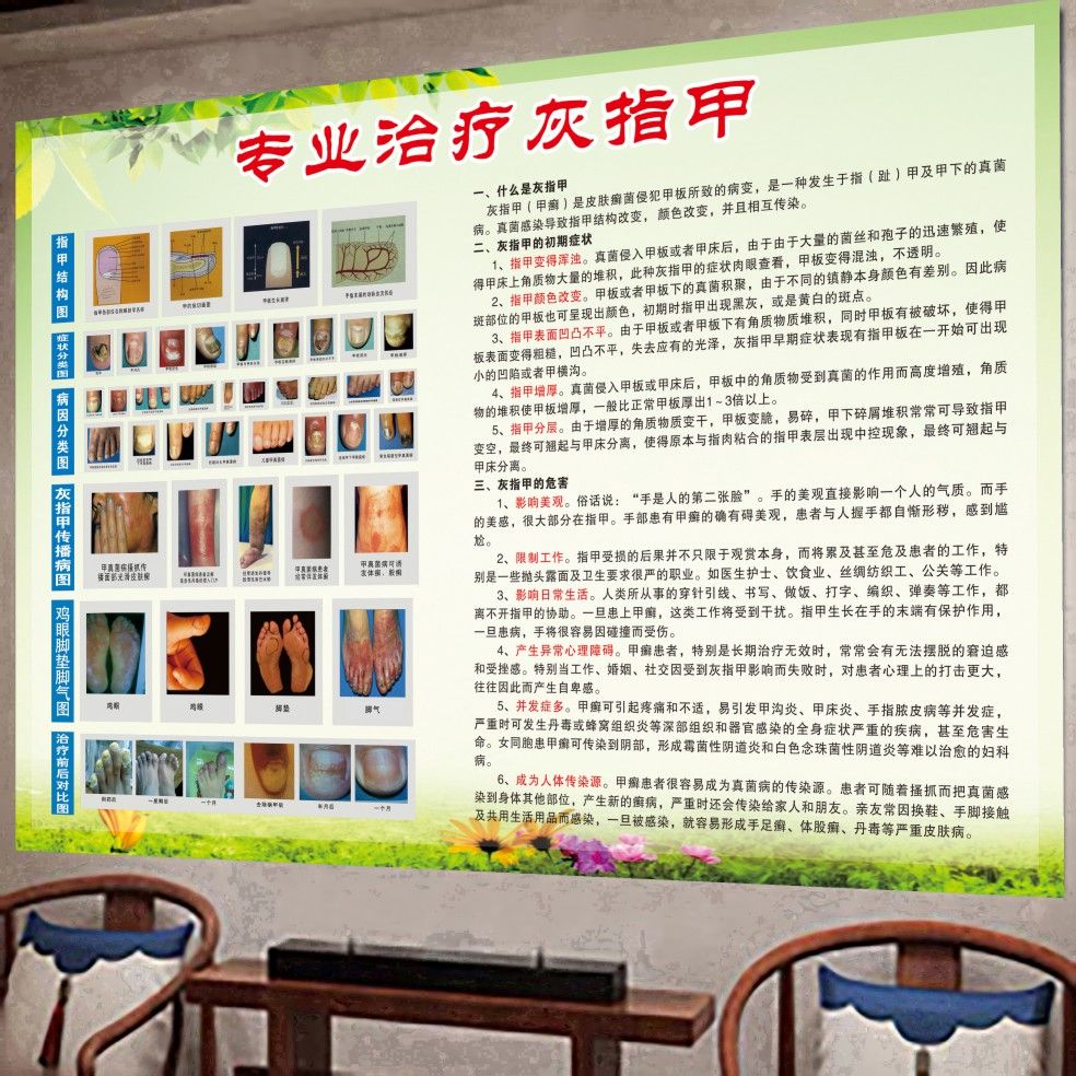 专业治疗灰指甲海报修脚店挂画甲沟炎手脚常见病广告宣传画贴纸