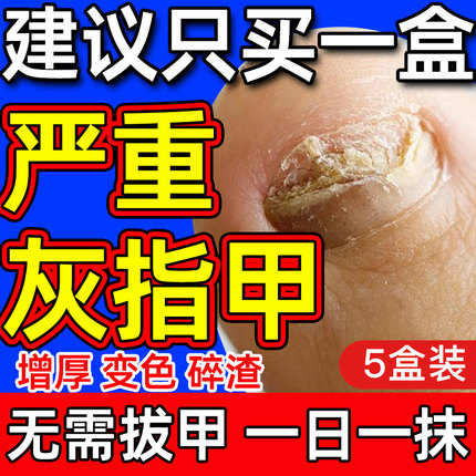 【自营】灰指甲特效药根治第一名专用药正品官方旗舰店亮治疗1甲