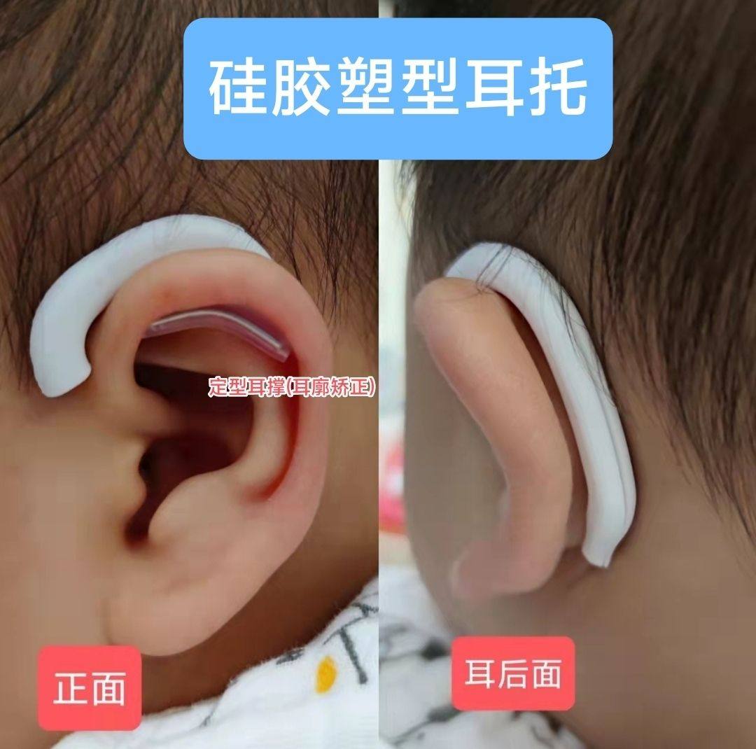 婴儿耳朵矫正器新生的儿耳廓矫形贴纠正塑形定型牵引器外耳垂宝宝