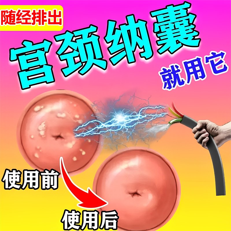 【宫颈囊肿】宫颈纳氏囊肿药妇科炎症豆腐渣白带宫颈糜烂肥大