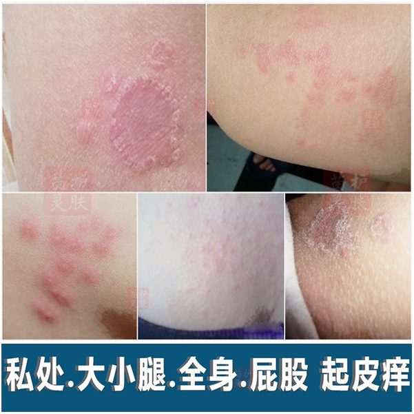 肛门周骚阴囊私处皮肤止痒