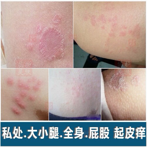 淹裆大腿两侧痒私处股沟鲜男女士骚药阴囊外阴潮湿烧裆用药2送1
