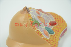 乳腺病变 乳房模型 乳房病变妇科模型 解剖模型 医学人体组织模型