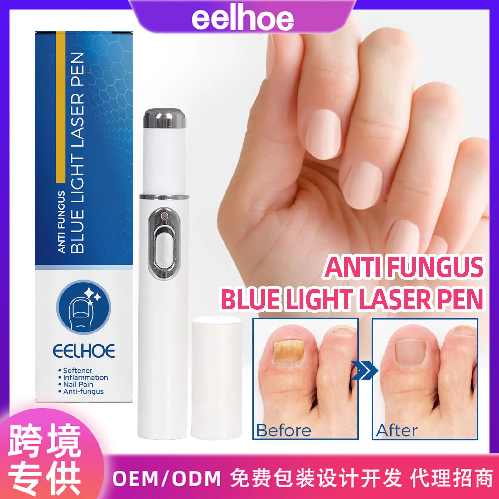 指甲蓝光激光笔灰指甲修护简单