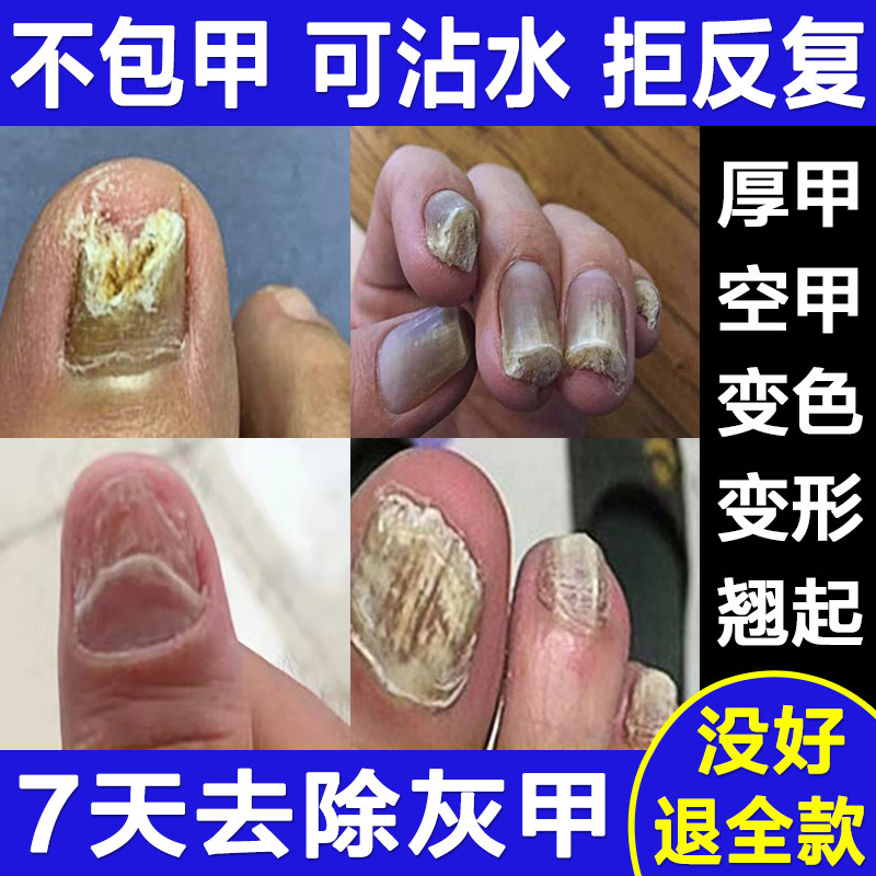去指甲沟灰水正品炎脱手指脚趾甲增厚发黄膏非亮甲旗舰店日本进口