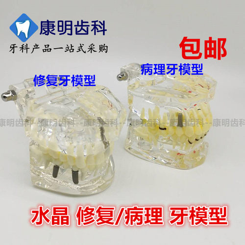 牙科材料 修复牙模型 水晶病理牙模型 活动种植牙模型 包邮 - 封面