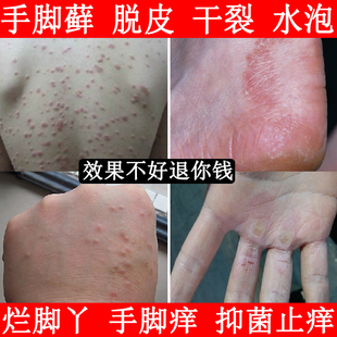虎毒膏止痒皮肤湿痒干燥荨麻疹过敏止痒断跟股藓大腿内侧瘙痒抑菌