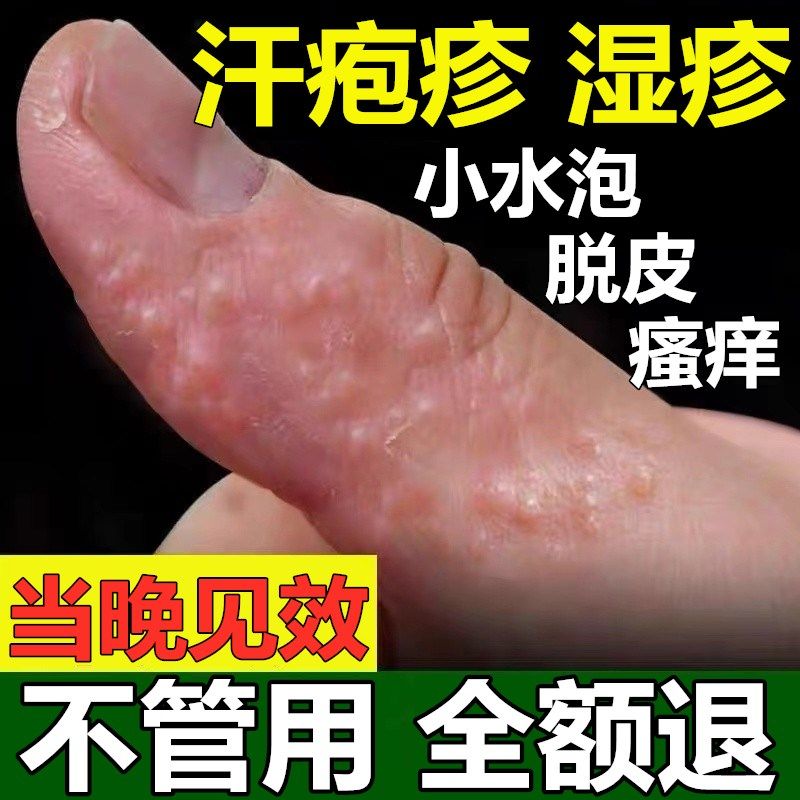 汗泡疱疹药膏汗状真菌感染手气膏手上起小水泡止痒专用汗疱疹孢疹_虎窝淘