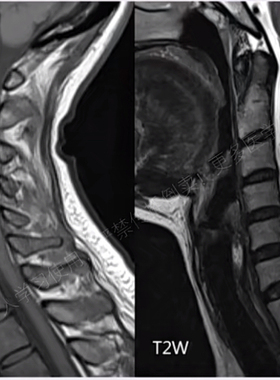 2026脊柱脊髓MRI磁共振解剖疾病视频课