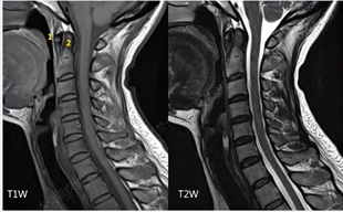 2026脊柱脊髓MRI磁共振解剖疾病视频课