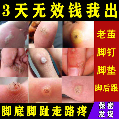 去脚垫专用鸡眼药水膏根手上脚底肉刺眼贴足部正品老茧去除软化剂