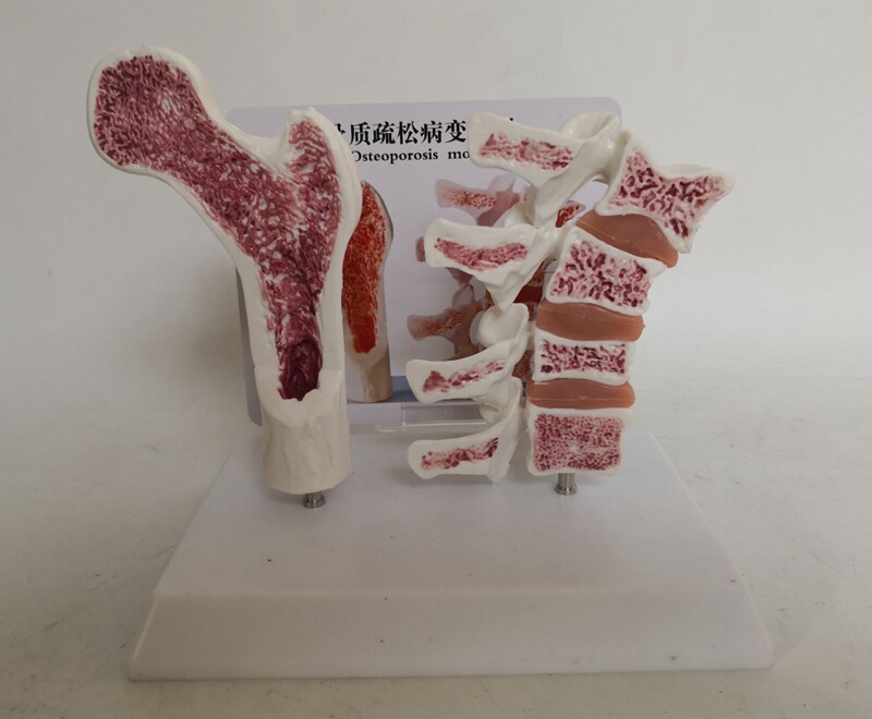 人体股骨头脊柱骨质疏松解剖比较模型 骨骼骨架 医用教学病理展示