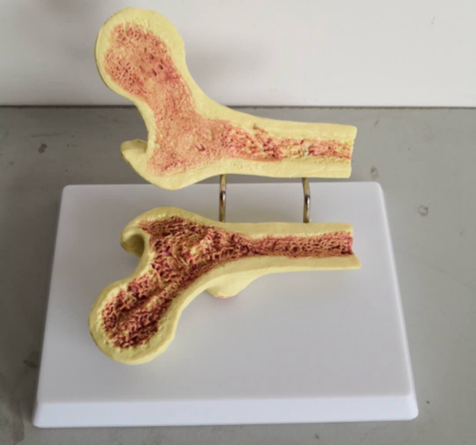 人体股骨头病变比较骨骼骨架