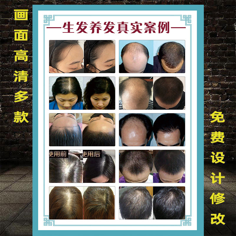 生发海报头发对比图护理广告植发图片养发馆装饰画头皮保养宣传画
