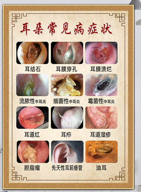 采耳图片宣传画耳病海报耳烛挂画