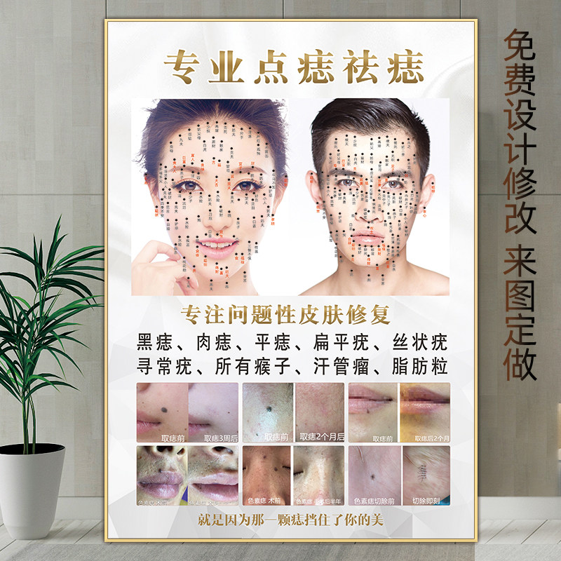 祛痣广告图点痣宣传图kt板男女面痣图取痣挂画痣相图祛痣祛疣海报