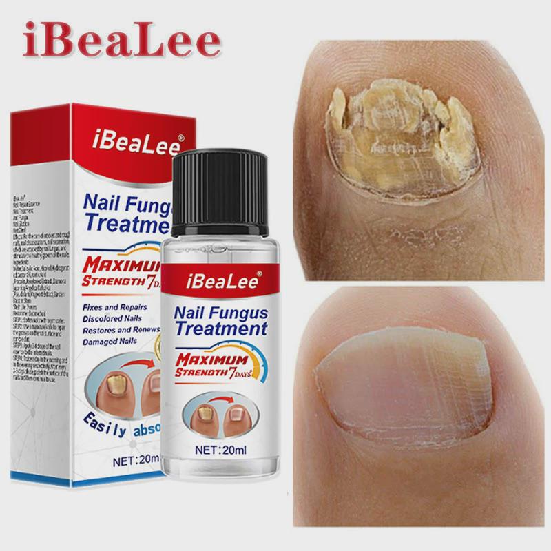 7 DAYS Nail Fungus Treatment Essence Feet Care Anti Infectio