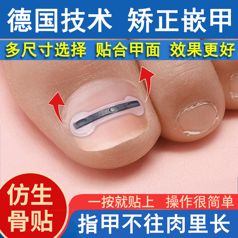 正甲贴片钛合金弹甲沟嵌矫正器脚趾甲盖内嵌神器专用指甲长肉里