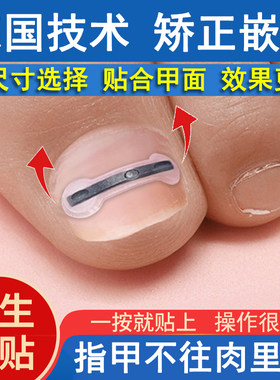 正甲贴片钛合金弹甲沟嵌矫正器