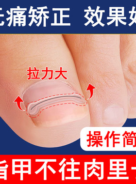 仿生骨贴甲沟嵌甲炎矫正器
