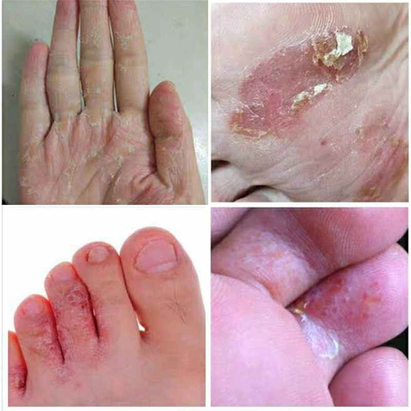 露脚季节脚裂恢复脚后跟干裂修护