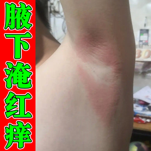 腋下淹红防腋窝胳肢窝红小疙瘩痒淹了红肿痛出汗多有异味痒