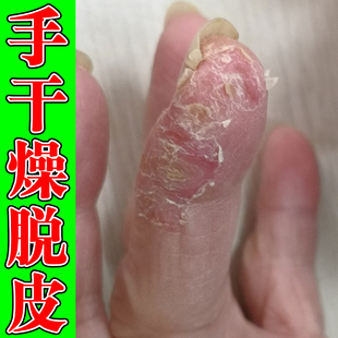 手干燥脱皮起皮手指干痒粗糙起硬皮掉皮屑手指尖脱皮掉皮外用乳膏