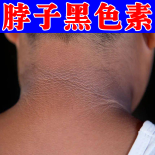 去脖子黑色素沉淀除脖子后面黑黑的洗不干净药黑棘皮外用乳膏