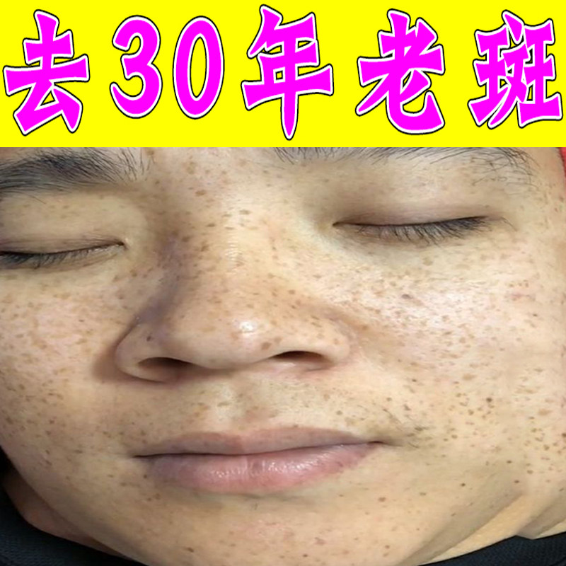脸上长黑褐色斑黄褐斑老年斑黑色素沉淀脸部黑斑黄褐斑雀斑软膏药