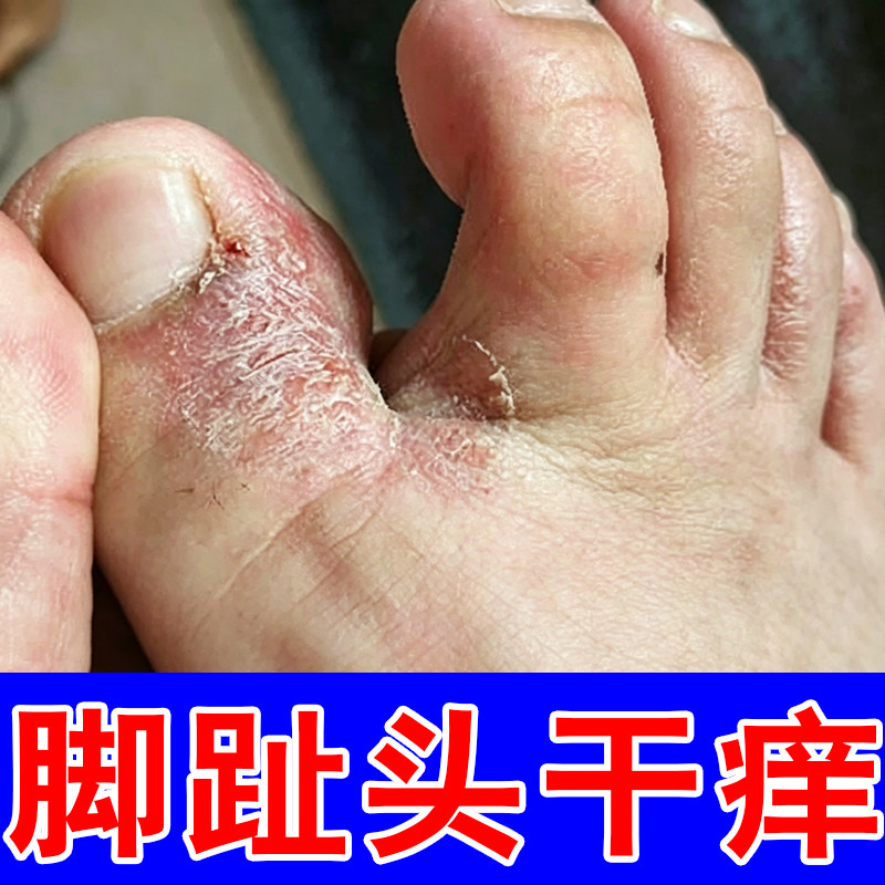 脚趾头干痒粗糙脱皮脚痒脚丫起皮脚趾缝干痒男女香港脚臭出汗喷雾