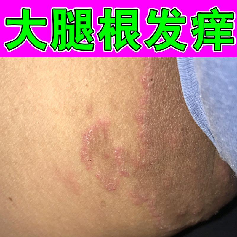 大腿根发痒起红斑干燥粗糙痒大腿内侧痒私处阴囊潮湿长丘疙瘩痒