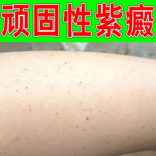 四肢皮下出起小红点小腿腿上长小红点皮下