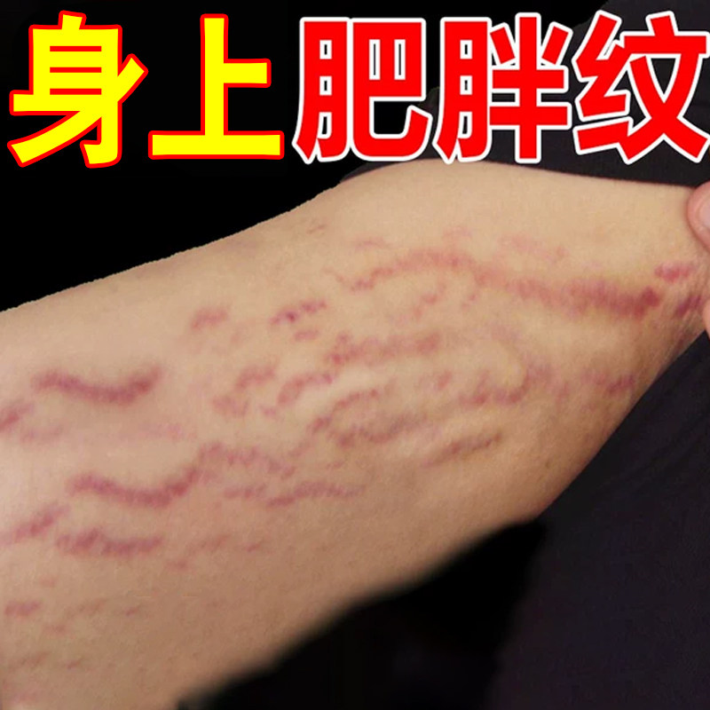 去肥胖纹修复霜生长纹消大腿学生膨胀纹除淡化白色纹理路男女通用