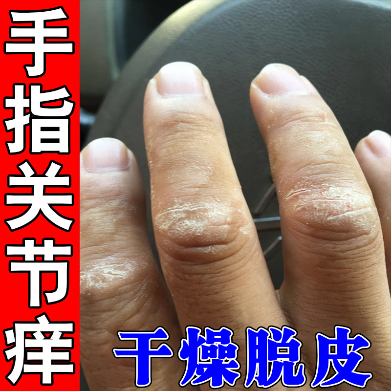 手指关节痒硬皮手指关节长硬疙瘩神经性手指开裂粗糙起皮掉皮软膏