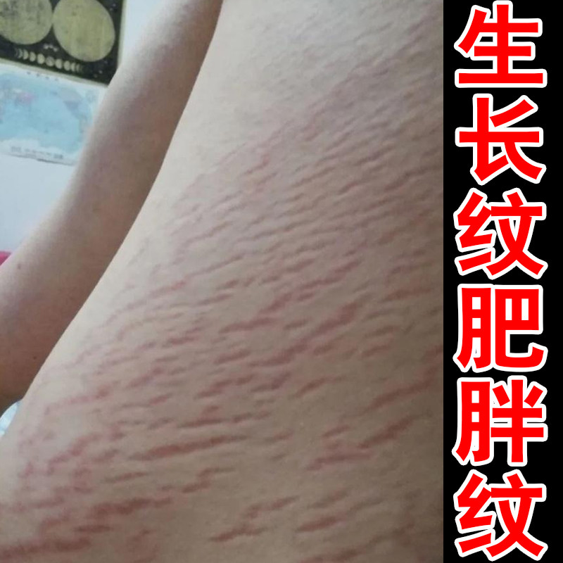 去肥胖纹修复霜生长纹消除大腿学生膨胀纹淡化白色纹理路男女通用