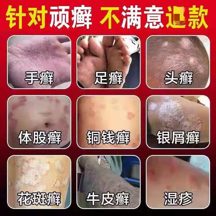 苗家牛皮药藓膏复方黄柏祛痒藓搽剂银藓痒病止外用痒瘙专用皮肤治