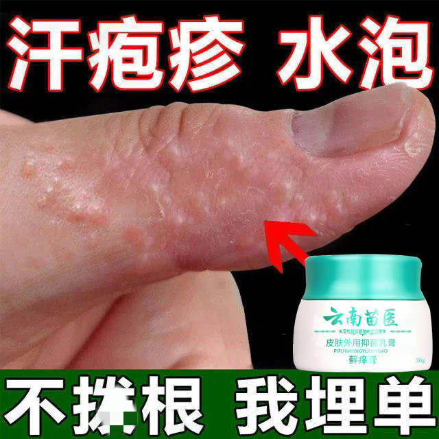 手藓手足藓鹅掌风湿汗疹疱止痒去皮疹干裂脱皮根真菌感染膏药