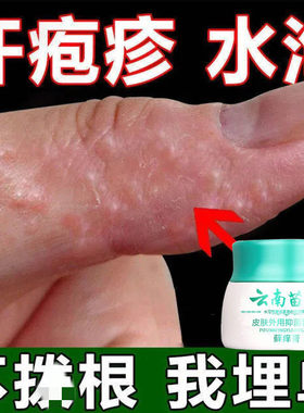 手藓手足藓鹅掌风湿汗疹疱止痒去皮疹干裂脱皮根真菌感染膏药