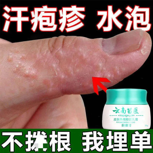 手藓手足藓鹅掌风湿汗疹疱止痒去皮疹干裂脱皮根真菌感染膏药