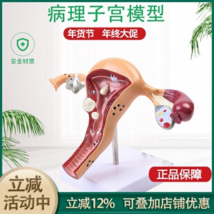 女病理子宫模型 女妇产子宫结构解剖 高级仿真病态子宫模型包邮